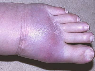 gout in left foot