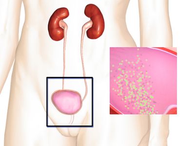 Urinary tract Infection woman illustration